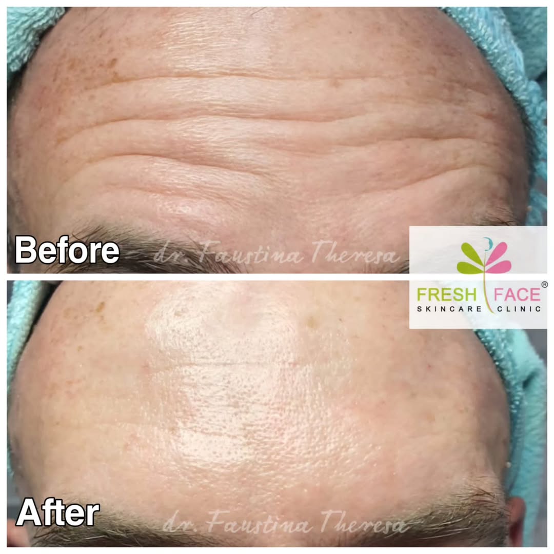 Botox Upper Face